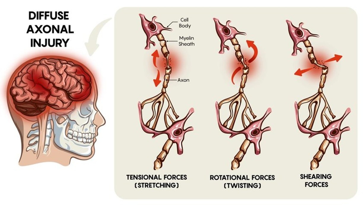 Diffuse-Axonal-Injury - Sirichet.com